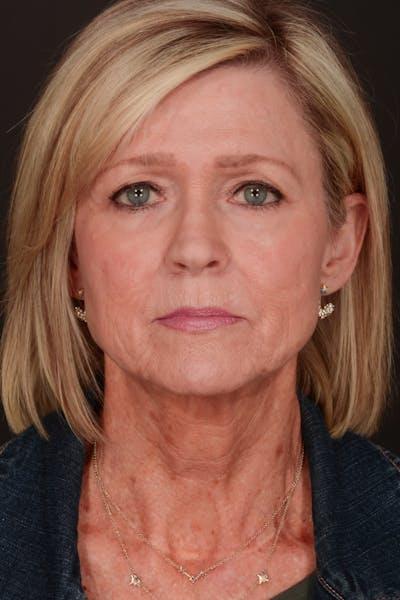 Facelift before at Meade Aesthetic Surgery in Dallas, TX