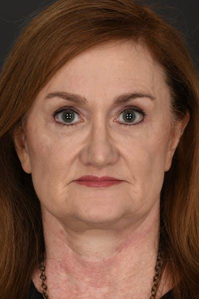 Meade Aesthetic Surgery after — Dallas, TX