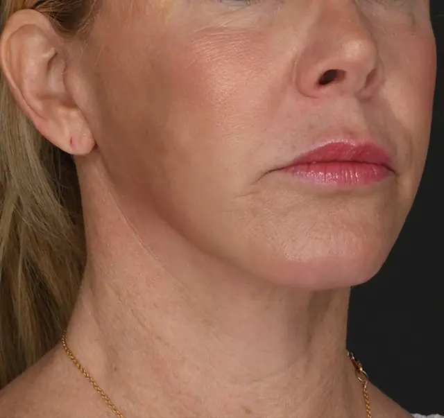 Neck Lift after at Meade Aesthetic Surgery in Dallas, TX