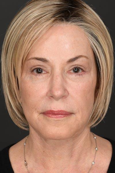 Meade Aesthetic Surgery after — Dallas, TX