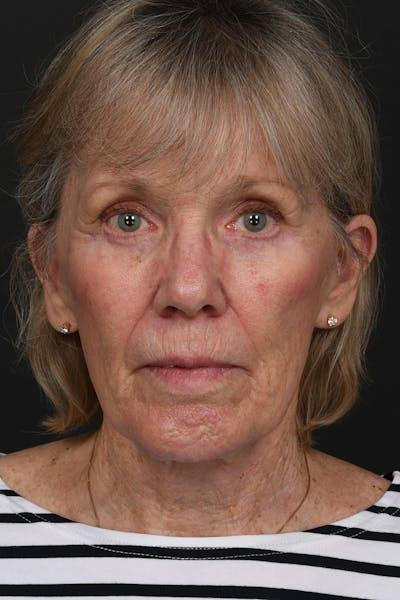 Meade Aesthetic Surgery after — Dallas, TX