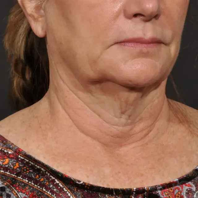 Neck Lift before at Meade Aesthetic Surgery in Dallas, TX