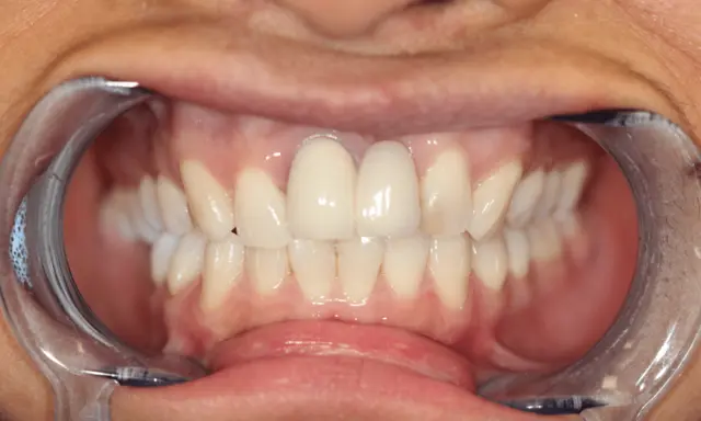 Invisalign before at Station Park Dental in Farmington, UT