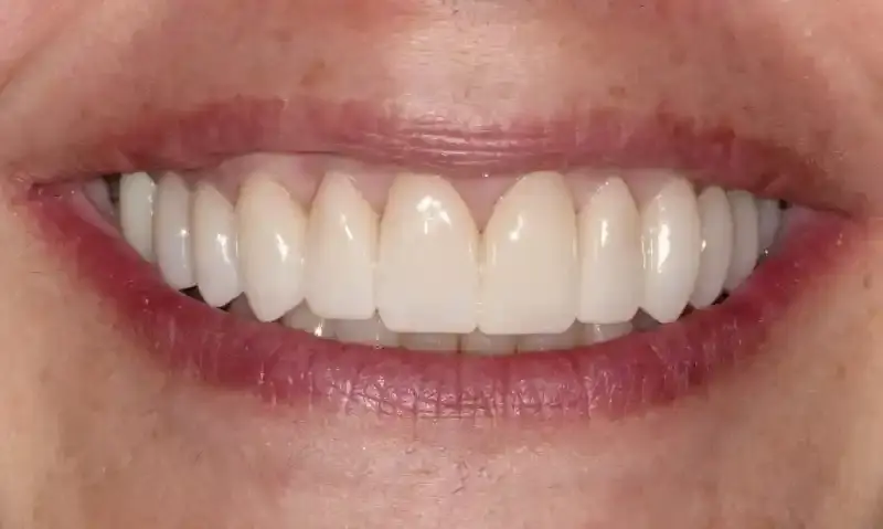 Station Park Dental veneers after — Farmington, UT