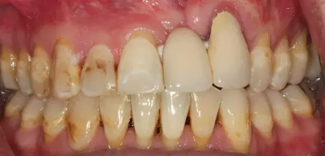 Dental Crowns before at Station Park Dental in Farmington, UT