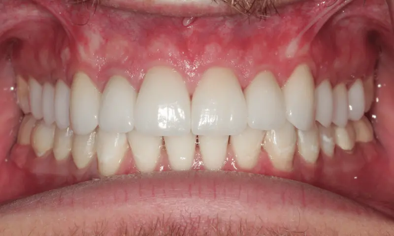 Station Park Dental veneers after — Farmington, UT