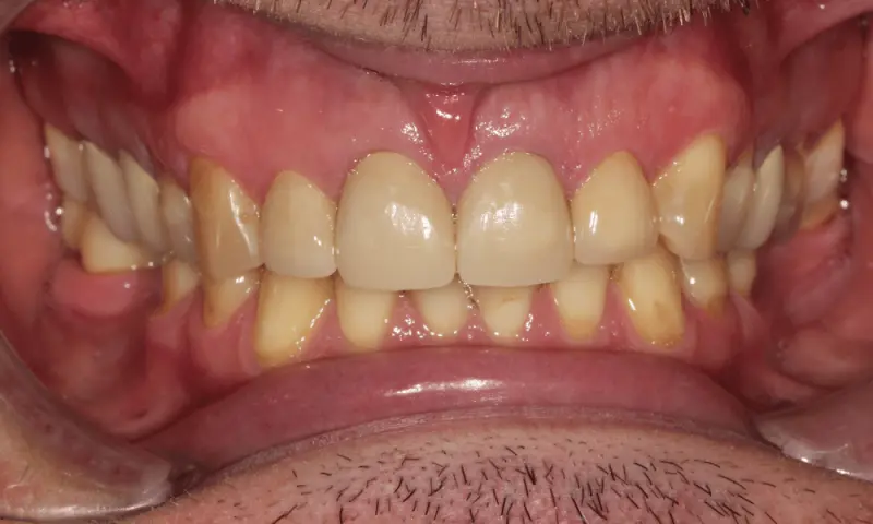 Station Park Dental smile makeover after — Farmington, UT
