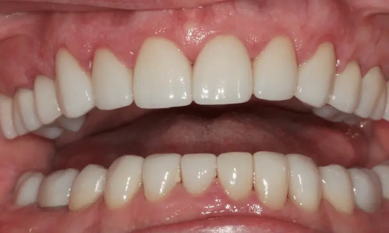 Station Park Dental smile makeover after — Farmington, UT
