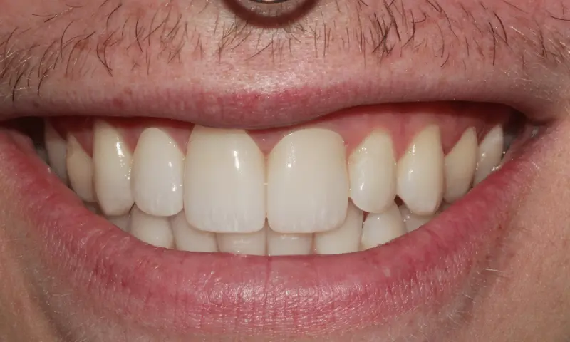 Station Park Dental veneers after — Farmington, UT