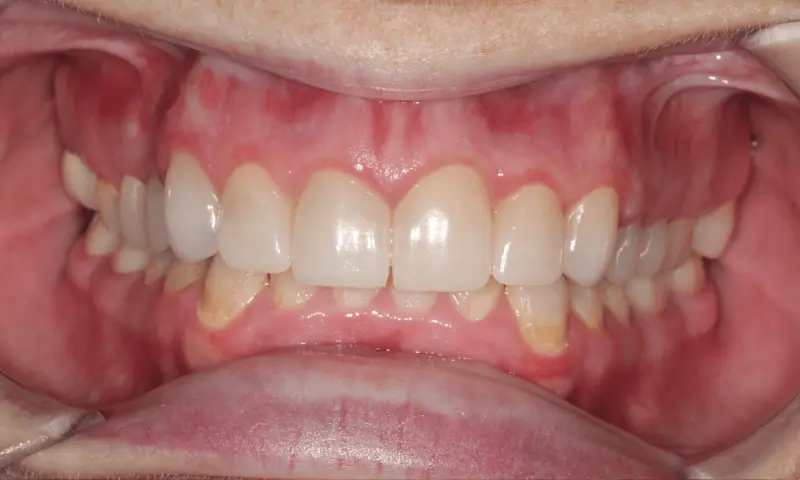 Station Park Dental smile makeover after — Farmington, UT