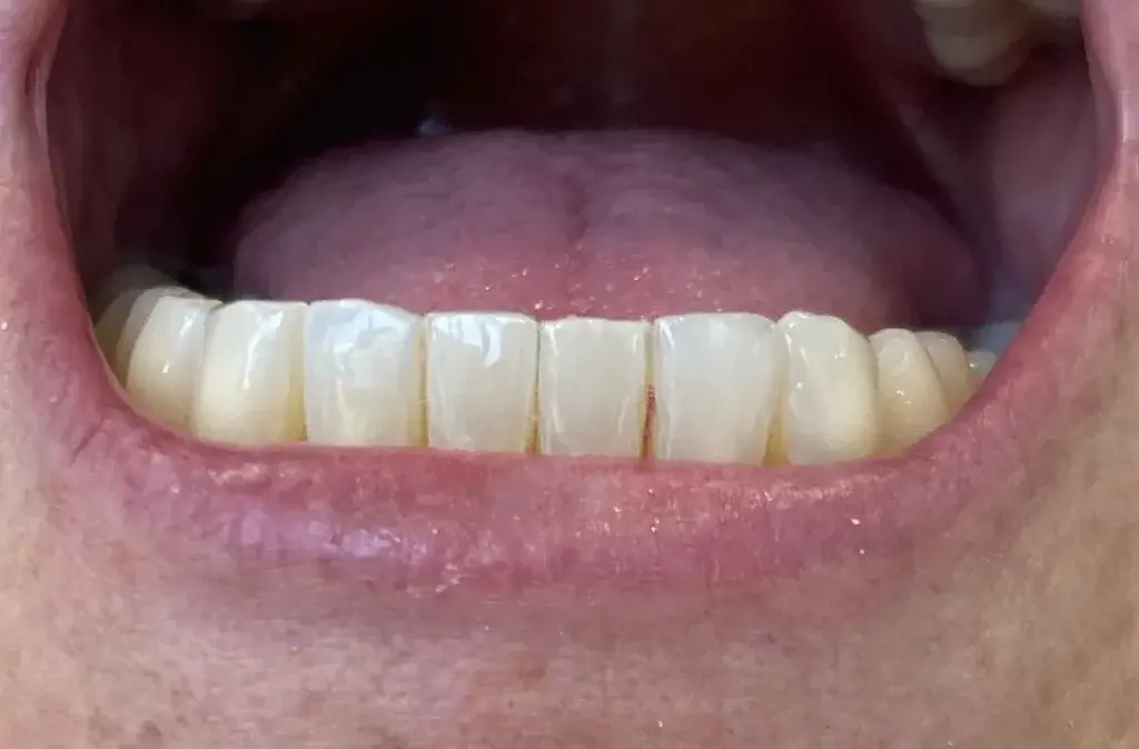Plain City Family Dental veneers after — Plain City, UT