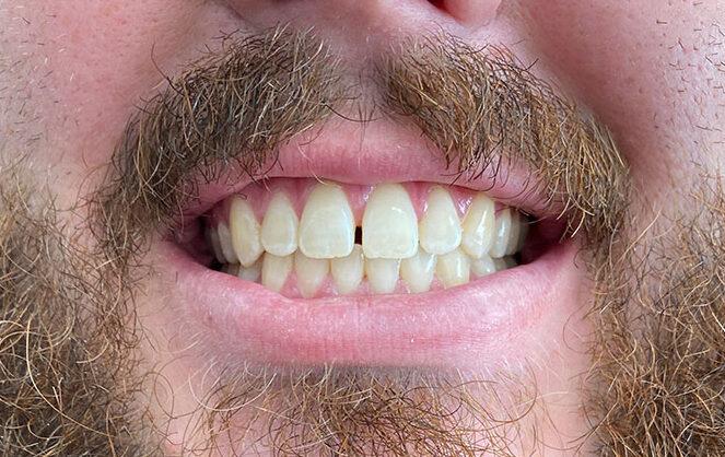 Plain City Family Dental veneers after — Plain City, UT