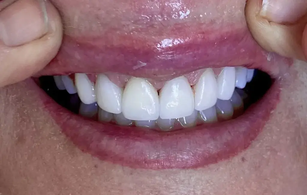 Plain City Family Dental veneers after — Plain City, UT
