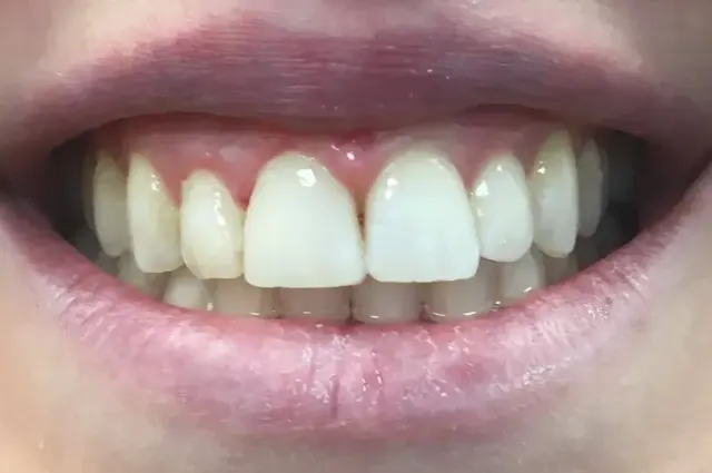 Dental Veneers after at Plain City Family Dental in Plain City, UT