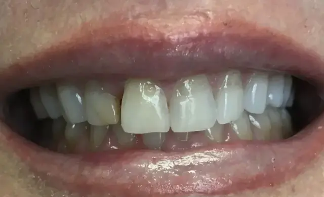 Dental Veneers before at Plain City Family Dental in Plain City, UT