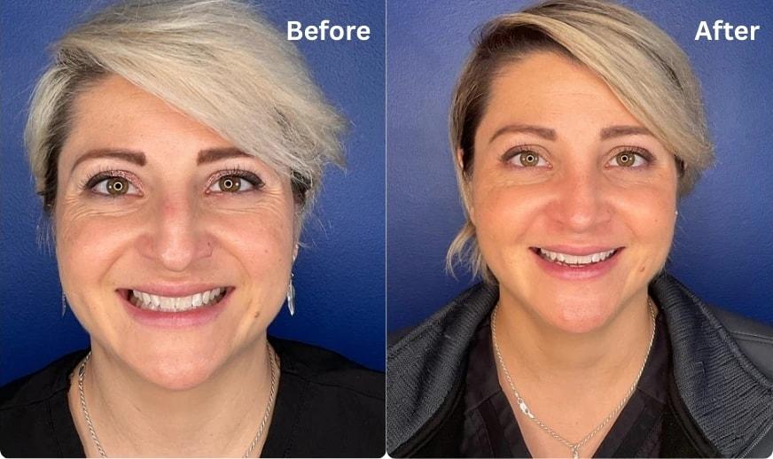 Cilento Facial Plastics rhinoplasty result — Spring, TX