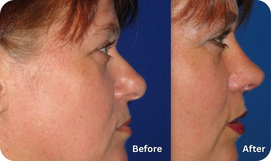 Cilento Facial Plastics rhinoplasty result — Spring, TX