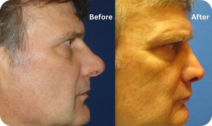 Cilento Facial Plastics rhinoplasty result — Spring, TX