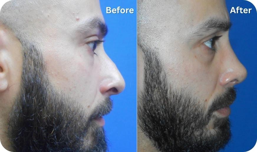 Cilento Facial Plastics rhinoplasty result — Spring, TX