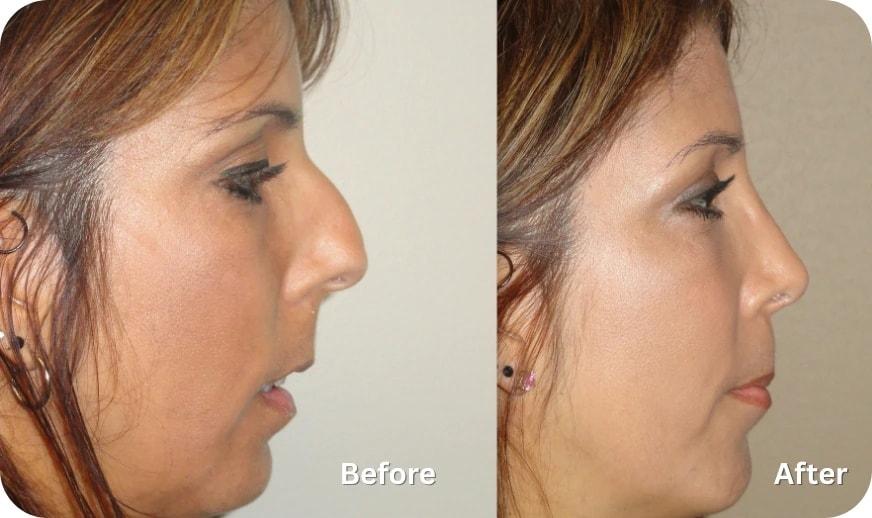 Cilento Facial Plastics rhinoplasty result — Spring, TX