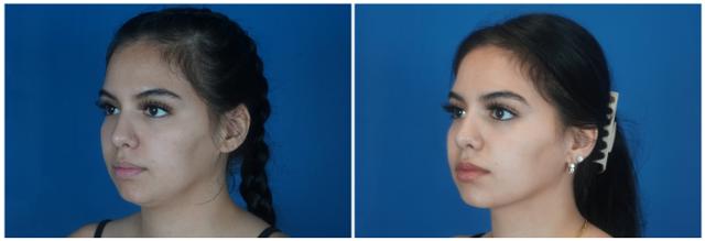 Neck Liposuction result at Dr. Ashley Steinberg - Trouvaille Aesthetics & Plastic Surgery in Houston, TX