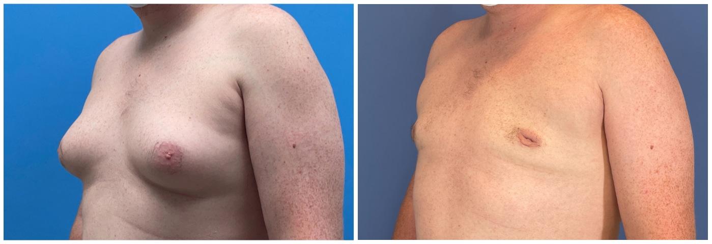 Dr. Ashley Steinberg - Trouvaille Aesthetics & Plastic Surgery gynecomastia result — Houston, TX