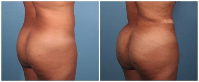 Brazilian Butt Lift result at Dr. Ashley Steinberg - Trouvaille Aesthetics & Plastic Surgery in Houston, TX