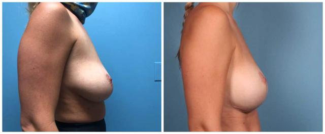 Breast Lift result at Dr. Ashley Steinberg - Trouvaille Aesthetics & Plastic Surgery in Houston, TX
