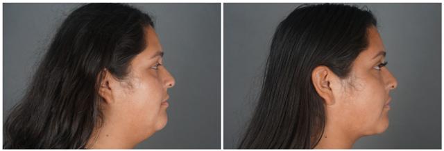Liquid Rhinoplasty result at Dr. Ashley Steinberg - Trouvaille Aesthetics & Plastic Surgery in Houston, TX