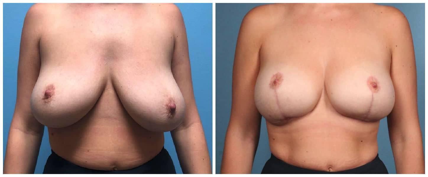 Dr. Ashley Steinberg - Trouvaille Aesthetics & Plastic Surgery breast lift result — Houston, TX