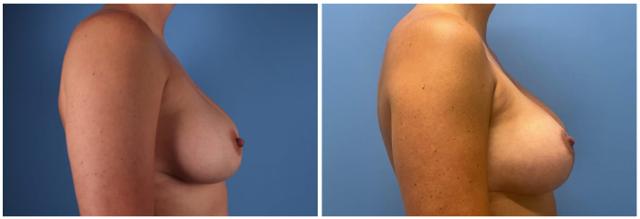 Breast Augmentation result at Dr. Ashley Steinberg - Trouvaille Aesthetics & Plastic Surgery in Houston, TX