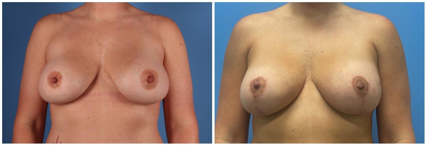 Dr. Ashley Steinberg - Trouvaille Aesthetics & Plastic Surgery result — Houston, TX