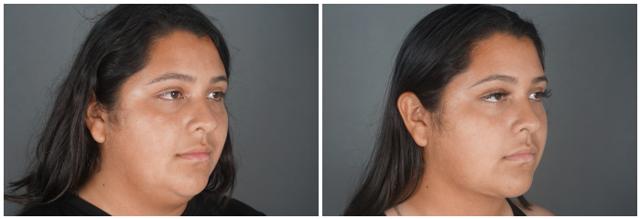 Neck Liposuction result at Dr. Ashley Steinberg - Trouvaille Aesthetics & Plastic Surgery in Houston, TX