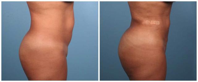 Brazilian Butt Lift result at Dr. Ashley Steinberg - Trouvaille Aesthetics & Plastic Surgery in Houston, TX