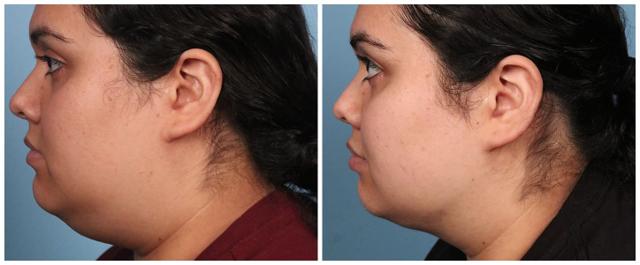 Liposuction result at Dr. Ashley Steinberg - Trouvaille Aesthetics & Plastic Surgery in Houston, TX