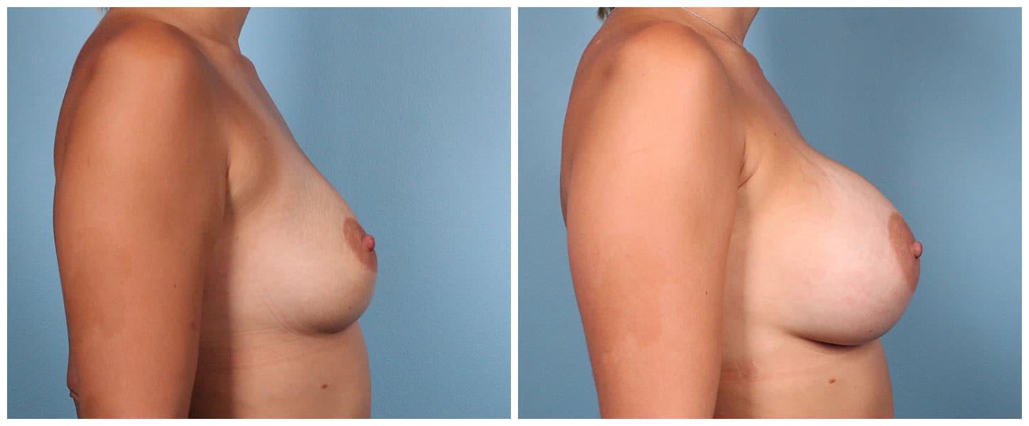 Dr. Ashley Steinberg - Trouvaille Aesthetics & Plastic Surgery result — Houston, TX