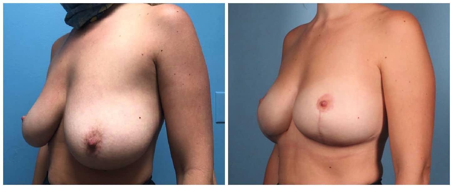 Dr. Ashley Steinberg - Trouvaille Aesthetics & Plastic Surgery breast lift result — Houston, TX