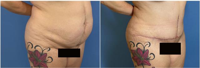 Mini Tummy Tuck result at Dr. Ashley Steinberg - Trouvaille Aesthetics & Plastic Surgery in Houston, TX