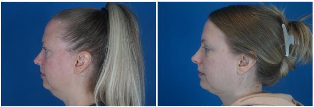 Neck Liposuction result at Dr. Ashley Steinberg - Trouvaille Aesthetics & Plastic Surgery in Houston, TX