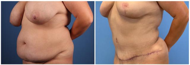 Mommy Makeover result at Dr. Ashley Steinberg - Trouvaille Aesthetics & Plastic Surgery in Houston, TX