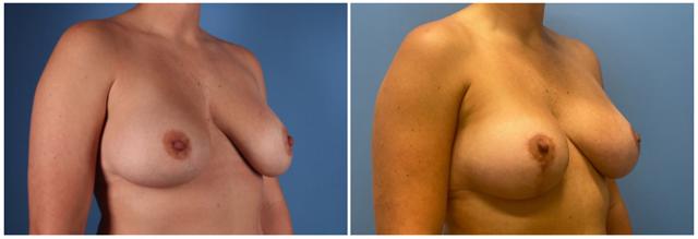Breast Lift result at Dr. Ashley Steinberg - Trouvaille Aesthetics & Plastic Surgery in Houston, TX