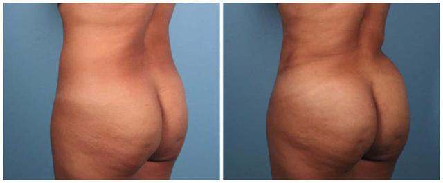 Brazilian Butt Lift result at Dr. Ashley Steinberg - Trouvaille Aesthetics & Plastic Surgery in Houston, TX