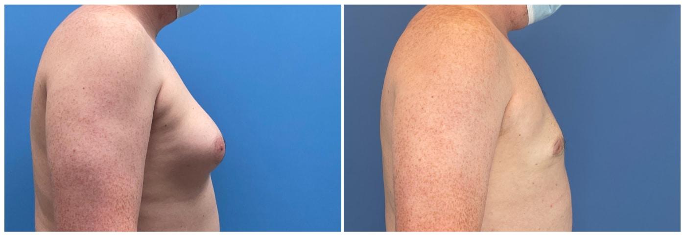Dr. Ashley Steinberg - Trouvaille Aesthetics & Plastic Surgery gynecomastia result — Houston, TX