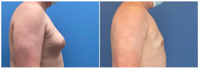 Gynecomastia Surgery result at Dr. Ashley Steinberg - Trouvaille Aesthetics & Plastic Surgery in Houston, TX