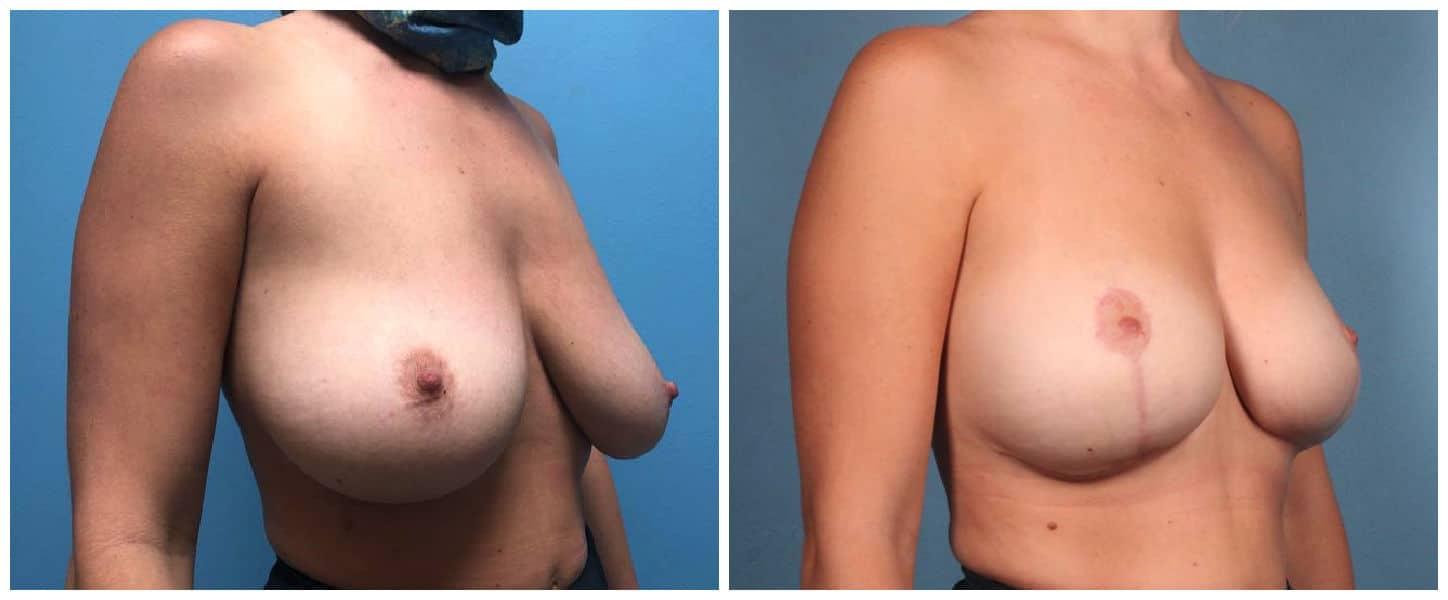 Dr. Ashley Steinberg - Trouvaille Aesthetics & Plastic Surgery breast lift result — Houston, TX
