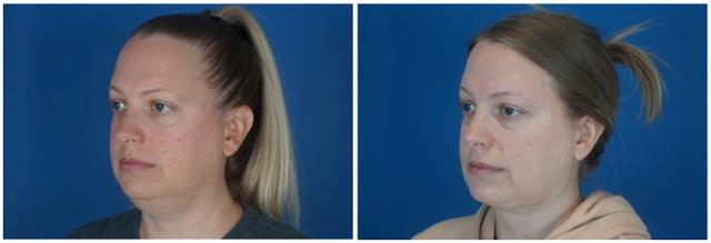Blepharoplasty result at Dr. Ashley Steinberg - Trouvaille Aesthetics & Plastic Surgery in Houston, TX