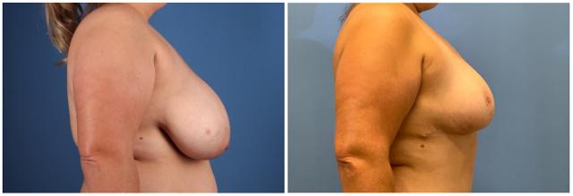 Breast Reduction result at Dr. Ashley Steinberg - Trouvaille Aesthetics & Plastic Surgery in Houston, TX