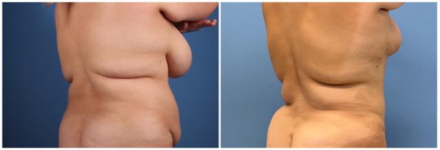 Mommy Makeover result at Dr. Ashley Steinberg - Trouvaille Aesthetics & Plastic Surgery in Houston, TX