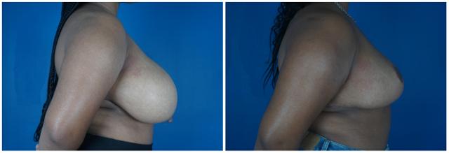 Breast Reduction result at Dr. Ashley Steinberg - Trouvaille Aesthetics & Plastic Surgery in Houston, TX