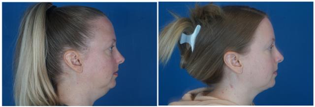 Neck Liposuction result at Dr. Ashley Steinberg - Trouvaille Aesthetics & Plastic Surgery in Houston, TX